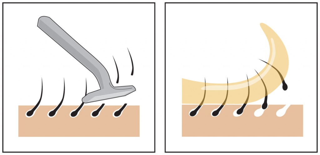 Удаление волос в подмышечных областях и в зоне бикини